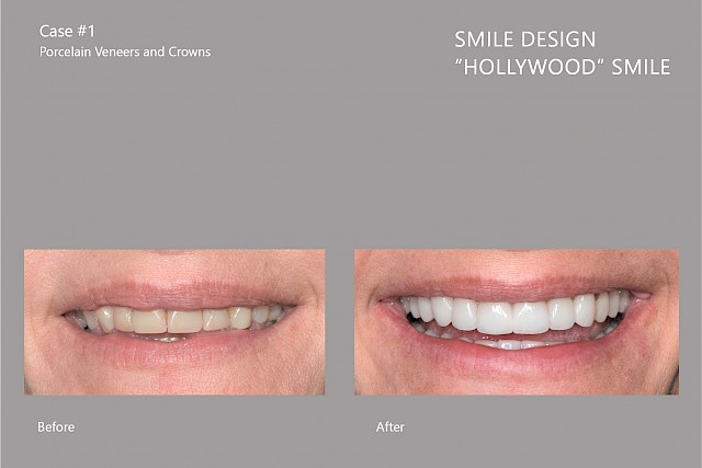 VIP Hollywood Smile | Smile Munich