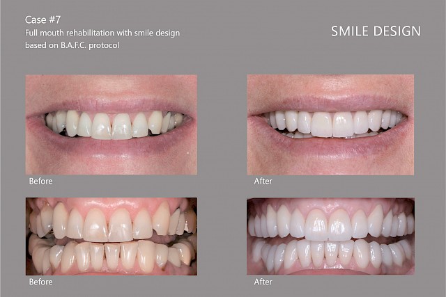 VIP Hollywood Smile | Smile Munich